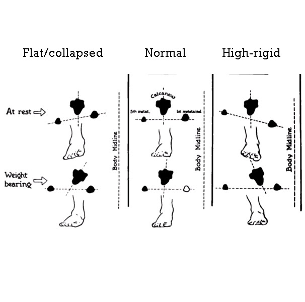 La ciencia de la disfuncion del pie y su cura Parte 3 – Altura del arco / Tipo de pie