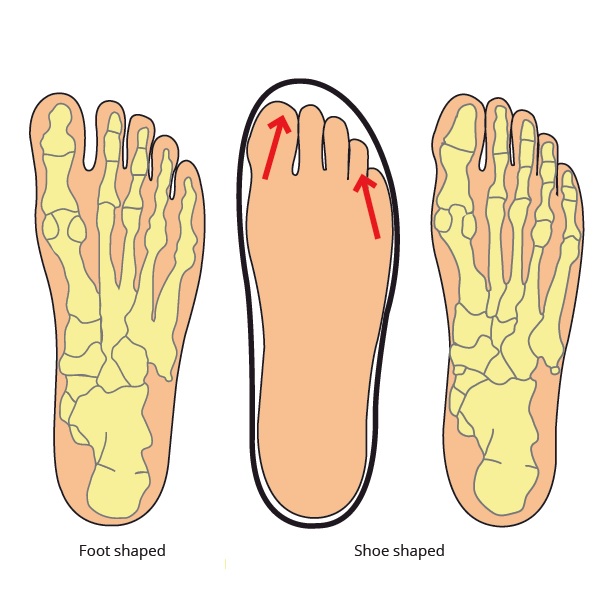 La ciencia de la disfuncion del pie y su cura Parte 2 – Posición del dedo gordo del pie